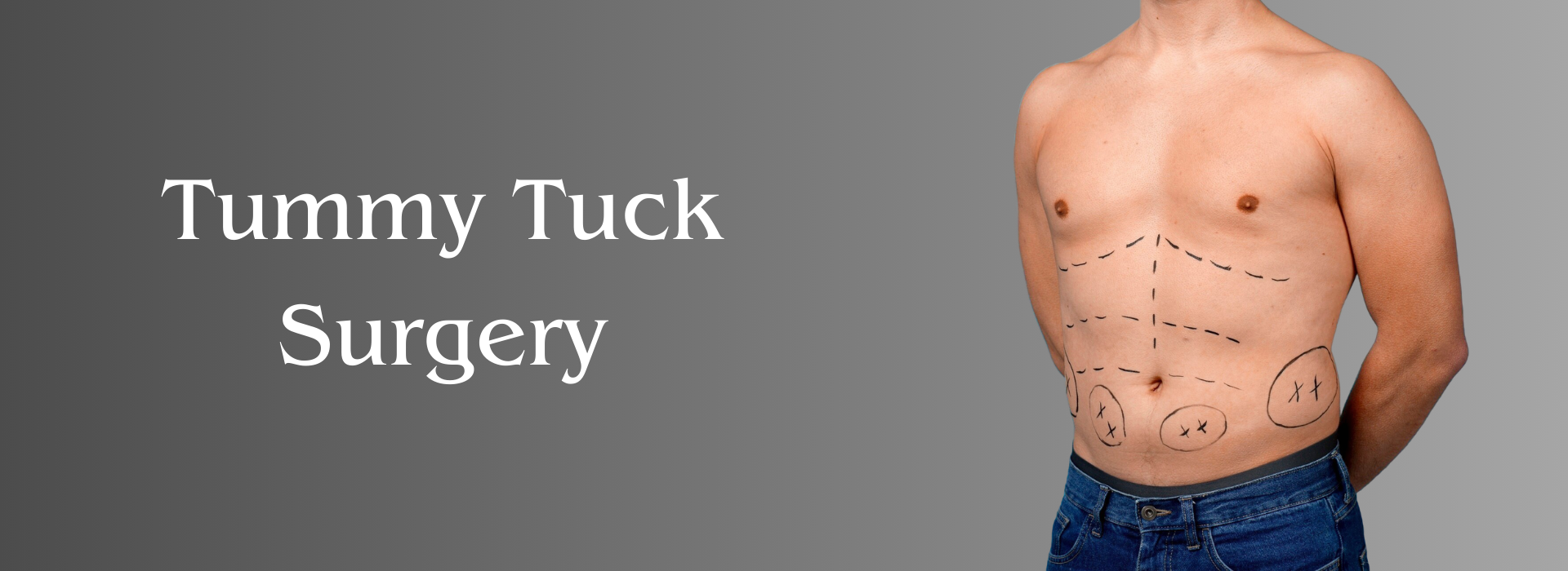 Tummy tuck surgery